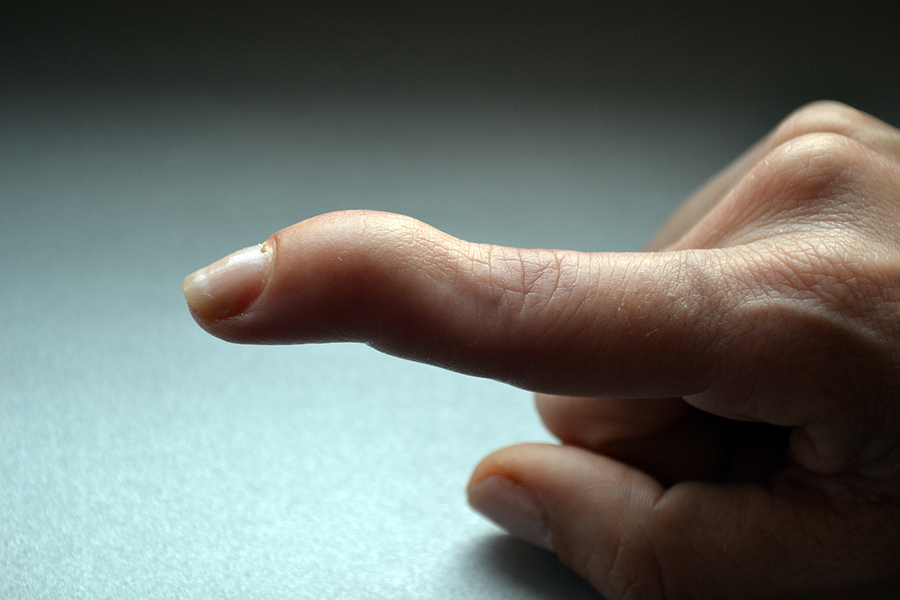 Çekiç Parmak (Mallet Finger) Deformitesi